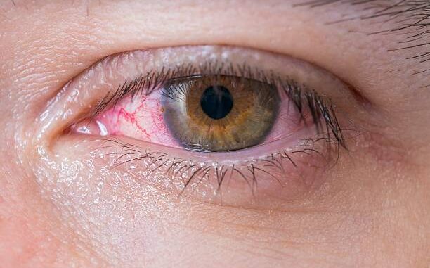 Macro of conjunctivitis red eye.